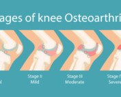 What are the different stages of knee osteoarthritis and possible management?
