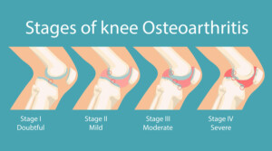 What are the different stages of knee osteoarthritis and possible management?